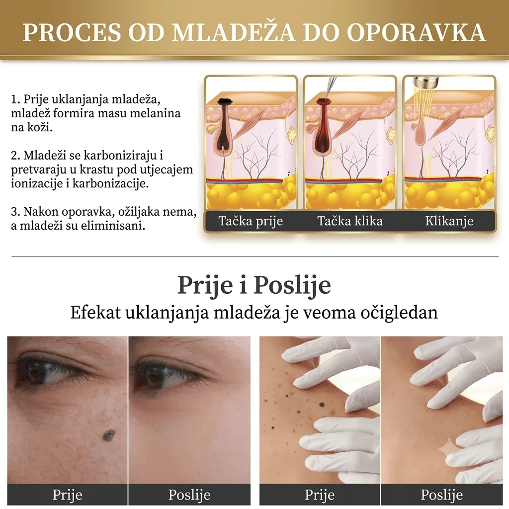 Plasma Pen aparat za preciznu kozmetičku njegu kože — slika 3